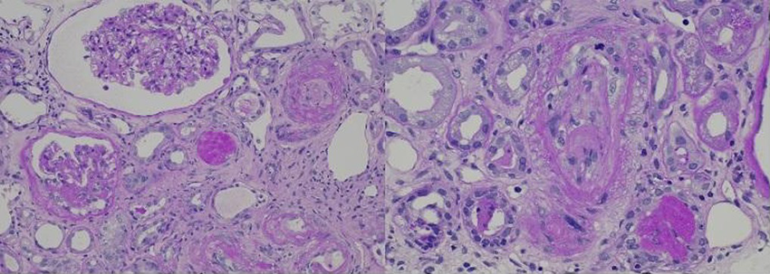 腎生検の拡大像（左：PAS染色×200，右×400）